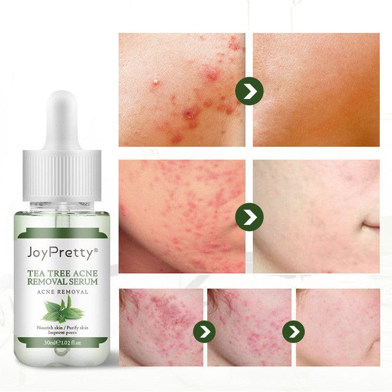 Fade Acne Marks And Acne Tea Tree Skin Care Essence Bennys Beauty World