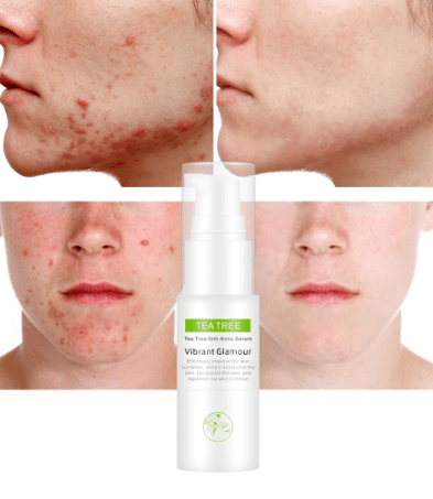 Tea tree acne cream BENNYS