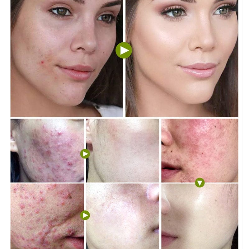 Tea tree acne cream BENNYS