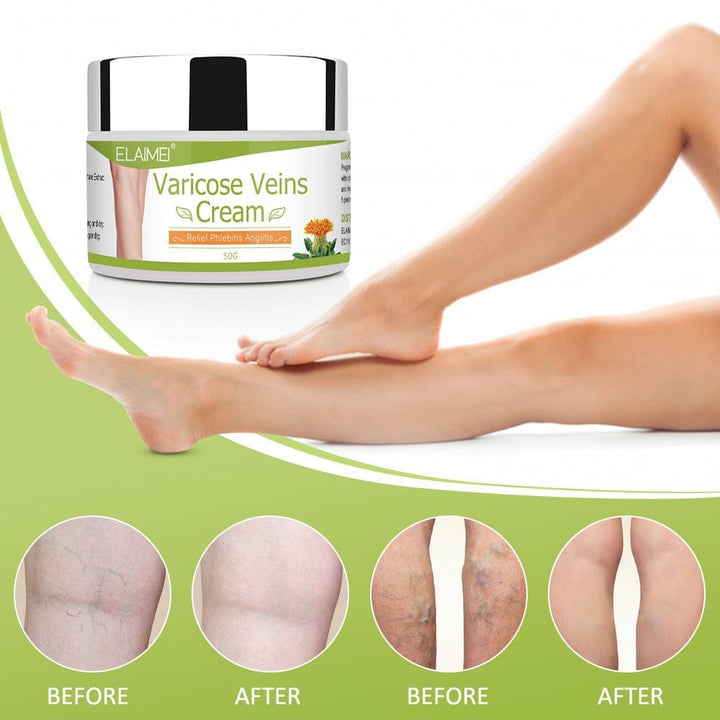 Varicose veins repair cream BENNYS